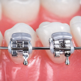 Elastic bracket guard placed over orthodontic brackets to prevent chipped teeth and bracket breakage from occlusal contact during braces treatment